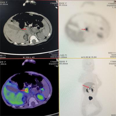 Laparoscopic Surgery for Focal-Form Congenital Hyperinsulinism Located in Pancreatic Head